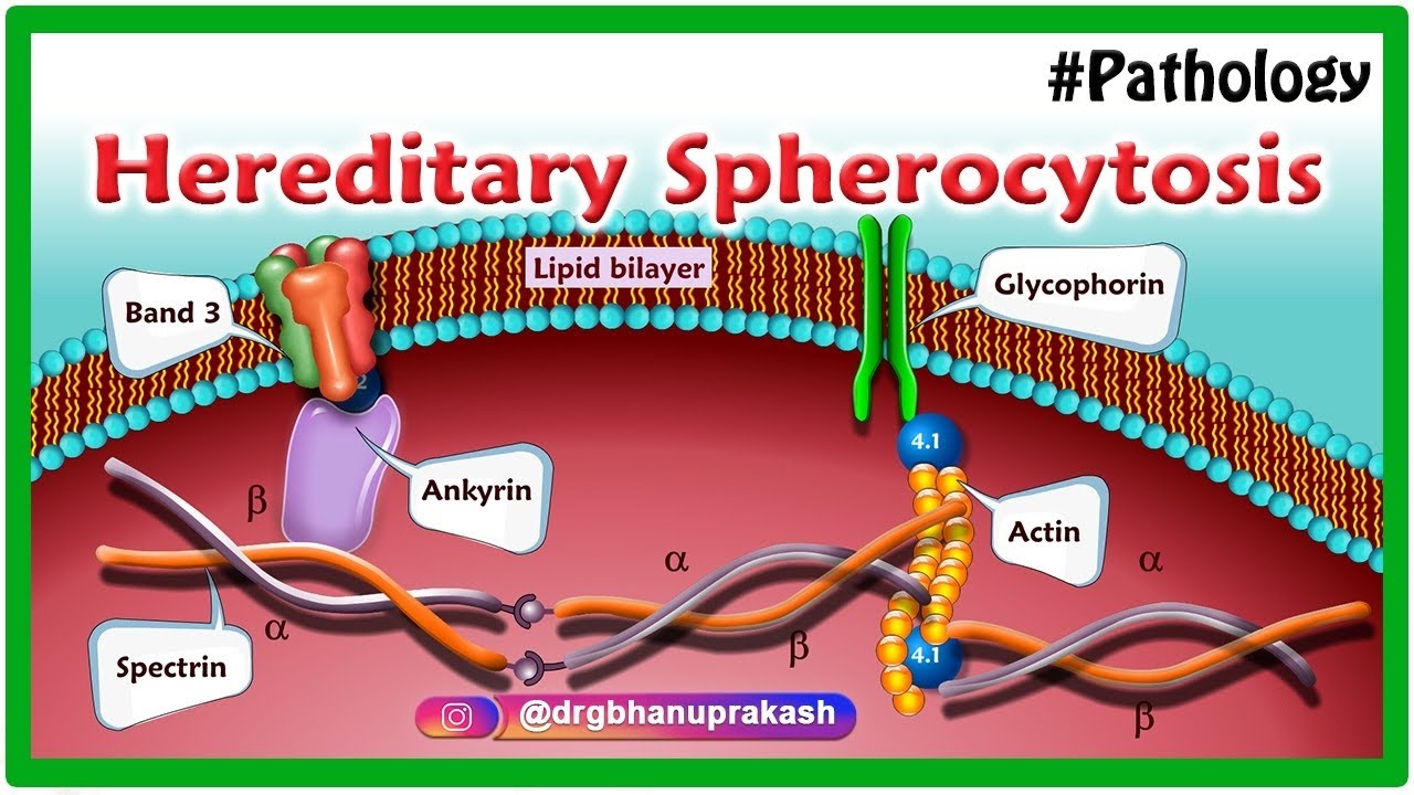 Hereditary Spherocytosis Animation Etiology Pathology Clinical hereditary-spherocytosis-animation-etiology-pathology-clinical