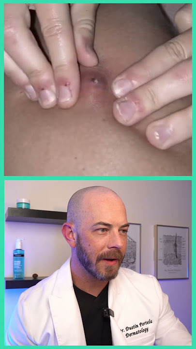 Derm reacts to SHOOTING abscess! #dermreacts #doctorreacts #abcess #pimplepop