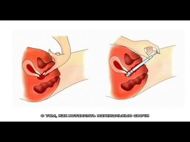 Как вставлять вагинальные свечи?