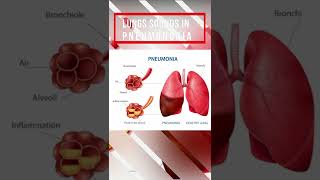 Lung sound in Pneumonia