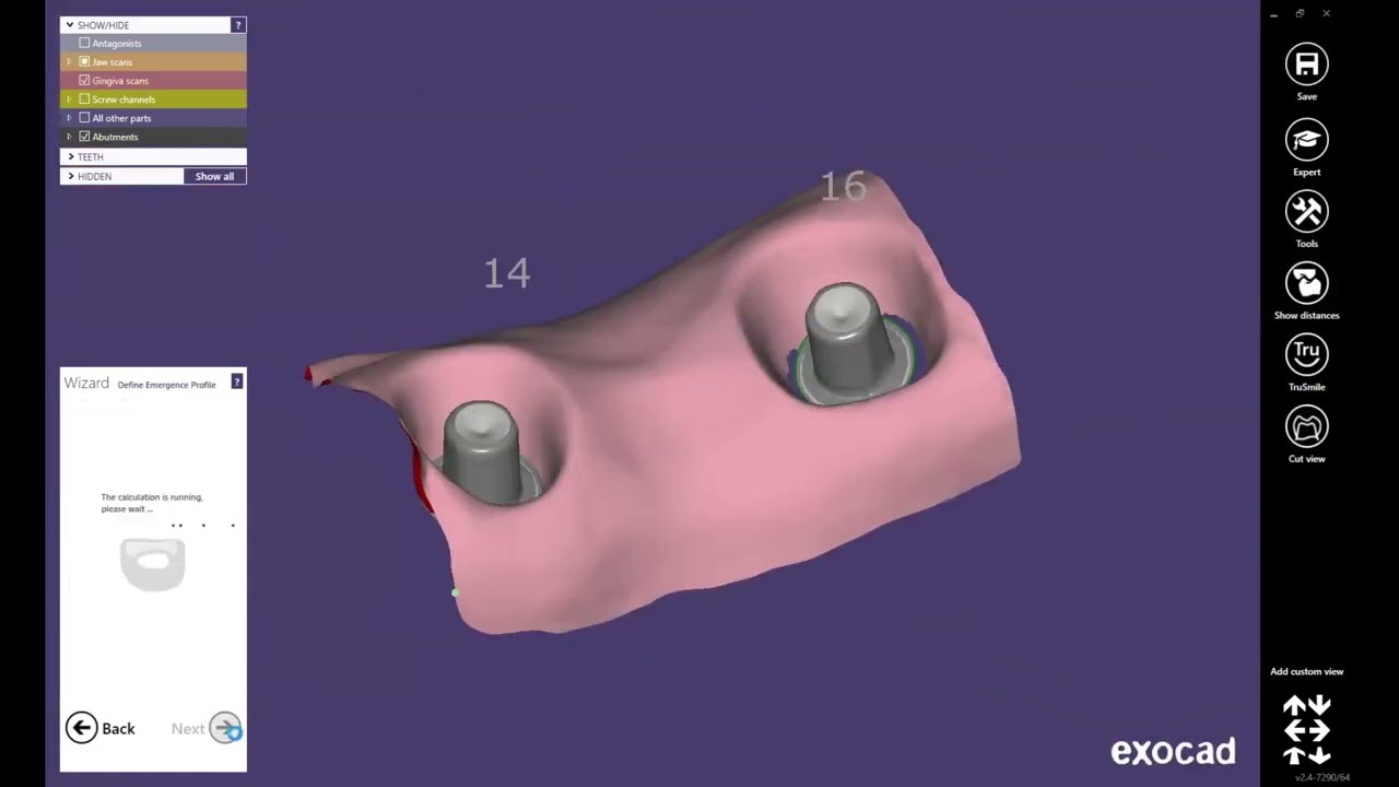 3D design implant bar using MeshMixer Free cad software