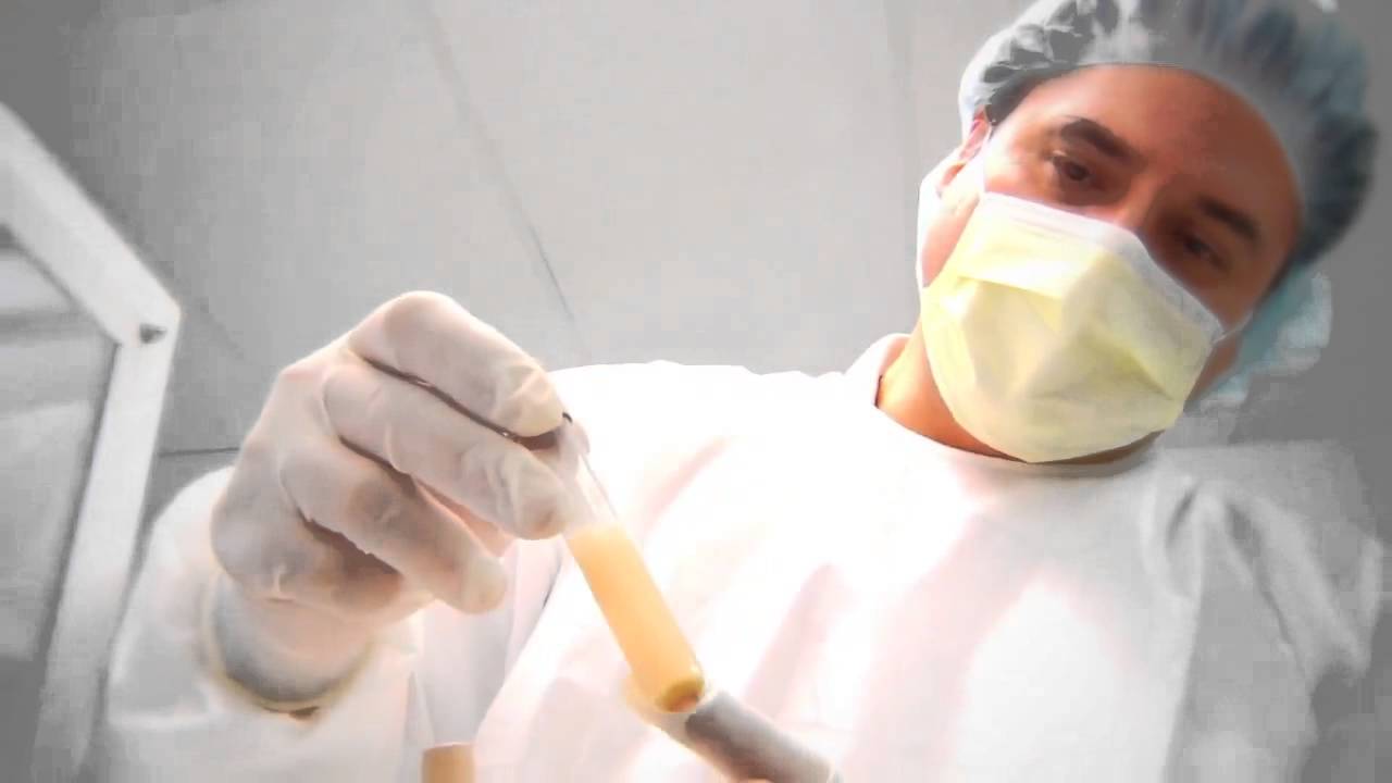 Adipose Derived Stem Cell Protocol by Regenestem Training - YouTube