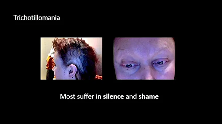 "What the Pluck? Living with Trichotillomania | Ju...
