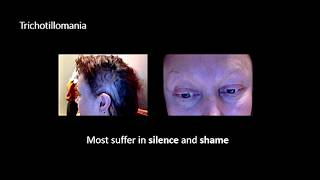 "What the Pluck? Living with Trichotillomania” | Judith Stevenson | TEDxUniversityofGlasgowSalon