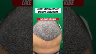 Hair transplant surgery hair hairstyle hairtransformation hairgrowth tranding viral  shorts l