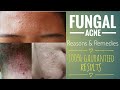 FUNGAL ACNE | Reasons & Remedies with 100% GAURANTEED RESULTS.