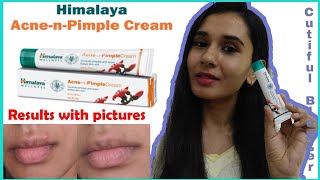 Himalaya Acne-n-Pimple Cream review | How to get rid of acne? Acne  treatment? @cutifulblogger - YouTube