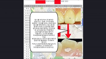 외상(다친) 앞니 치료 과정