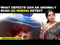 What defects can an anomaly scan 20weeks detect       