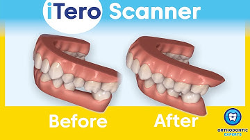 Orthodontic Technologies | iTero Scanner