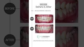 앞니로 면을 끊기도 어려운 #절단교합 #치아교정 을 통해 개선해보아요!