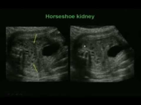 Anomalies of the Fetal Genitourinary Tract