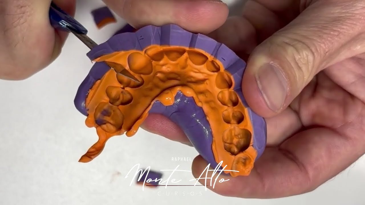 Mock up  para facetas cerâmicas.