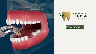 What Happens If You Don’t Replace Missing Teeth? Wealth