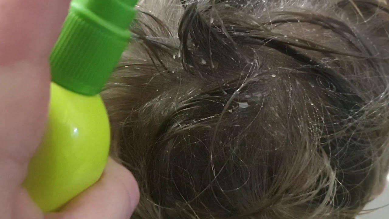 Get rid of nits. Fizzy 5 YouTube