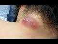 Popping huge blackheads and pimple popping  best pimple poppings 58