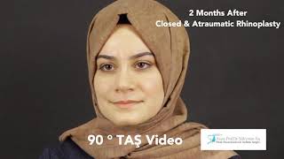 90° TAS Video | Suleyman TAS, MD, Assoc.Prof.