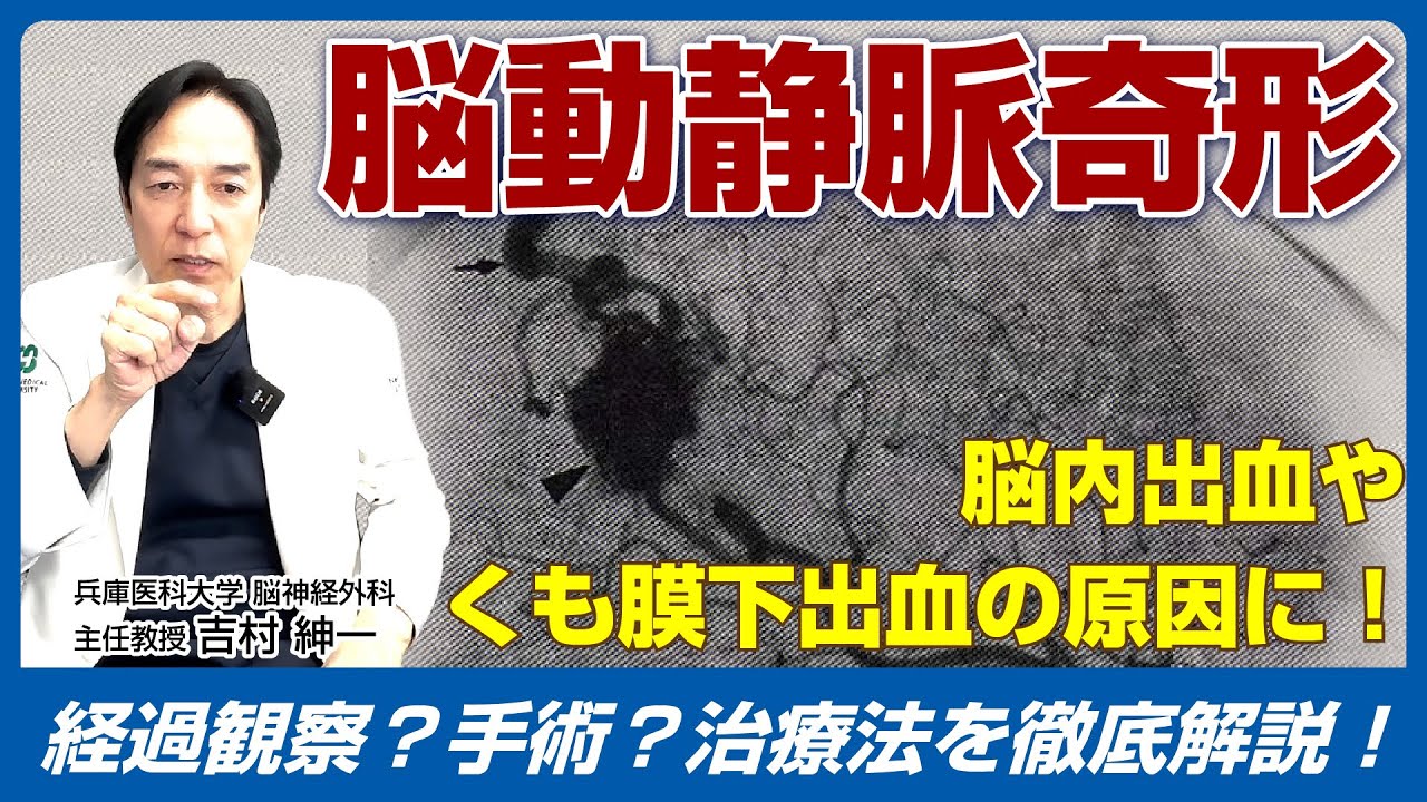 脳動静脈奇形とは？ 脳内出血やくも膜下出血の原因に！治療方法を徹底解説！