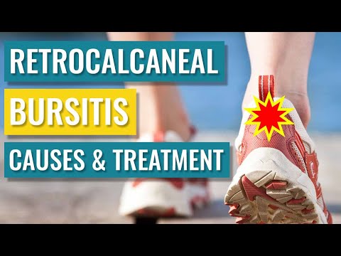 Videó: Achilles Bursitis: Tünetek, Kezelés, Fotók, Okok