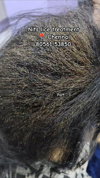 Nits lice treatment in Chennai 100% result #headliceremoval#headlice#liceremoval#licetreatment#nits
