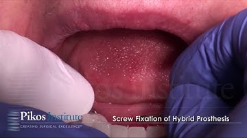 Dr. Michael A. Pikos - Guided Full Arch All on 4 Implant Treatment Plan