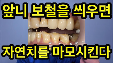 앞니 보철 씌울때 주의사항 DentiTube190116 포세린은 대합치를 마모시키므로 교합유도를 하면서도 마모를 안 시켜야