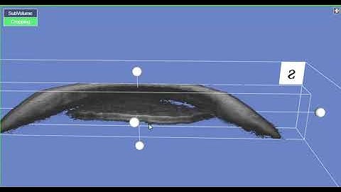 Virtual Gonioscopy Using TOPCON Triton OCT