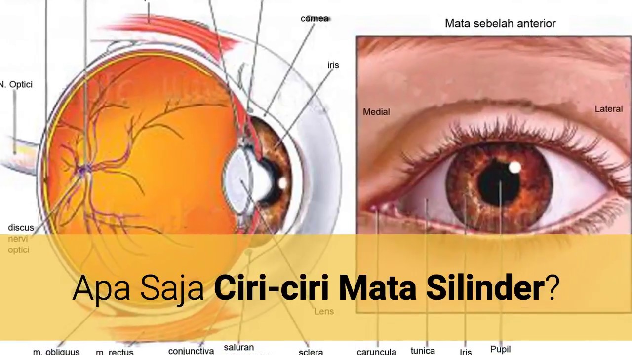 Ciri Ciri Mata Silinder Kenalilah Berikut Ini Ada 7 