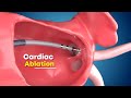 Cardiac ablation surgery 3d animation