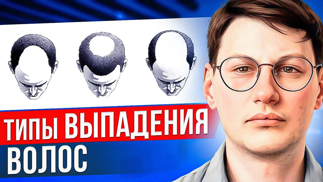 КАК ПОНЯТЬ СВОЙ ТИП ВЫПАДЕНИЯ? ТЕЛОГЕНОВОЕ ВЫПАДЕНИЕ | АГА | ТИПЫ ...