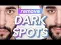 Remove Dark Spots / Acne Scars / Hyperpigmentation From The Face ✖ James Welsh