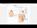 THYROGLOSSAL FISTULA | WHAT IS THYROGLOSSAL FISTULA?