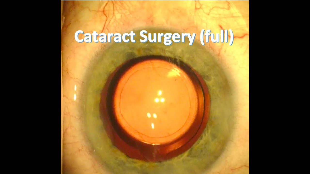 Full video of cataract surgery under topical anaesthesia YouTube