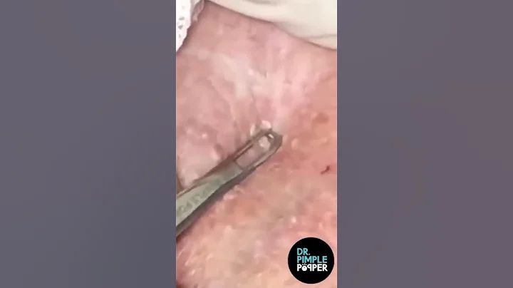 Whitehead kingdom  #popaholic #drpimplepopper