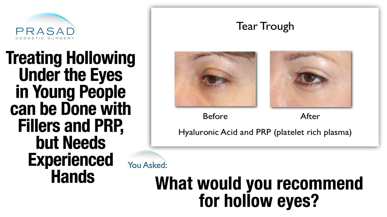 Download Treating Hollowness Under The Eyes Must Be Done Carefully Due To Thinness Of Eyelid Skin Youtube For Free Get Wallpaper Treating Hollowness Under The Eyes Must Be Done Carefully Due To Thinness Of Eyelid Skin Youtube For iPhone Free
