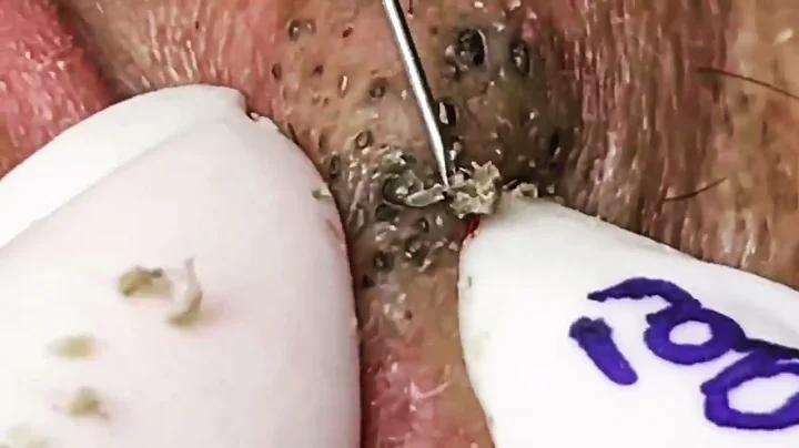 normes points noirs en grappe / Big asian blackheads