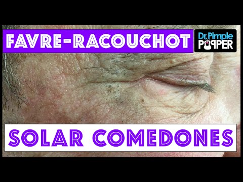 Extracting Solar Comedones, Blackheads Around The Eyes