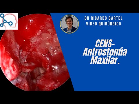 Antrostomía Maxilar como tratamiento de una Sinusitis Crónica Localizada.