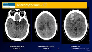 Emergency Imaging of Brain Tumors: Astrocytomas