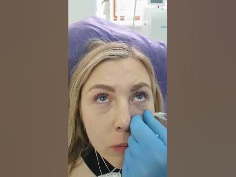 Вводим филлер под глаза. - YouTube