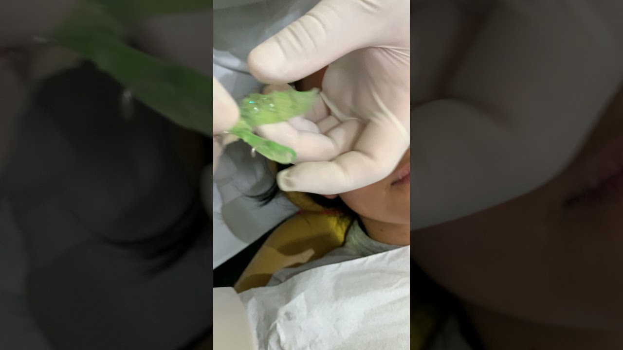 RETENEDOR HAWLEY Y SU ACTIVACIÓN CON PINZAS