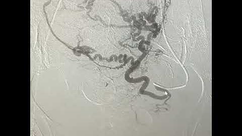 Inside look at Uterine Fibroid embolization.
