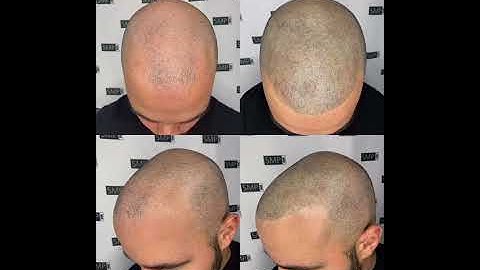 SMP Ink - Before and After Scalp Micropigmentation!