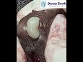 Popped scrotal cysts 