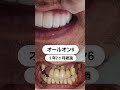 歯周病で歯が残せない方もオールオン6で噛めるように、美しくできます #インプラント#サイナスリフト#ソケットリフト#難症例#オールオン4