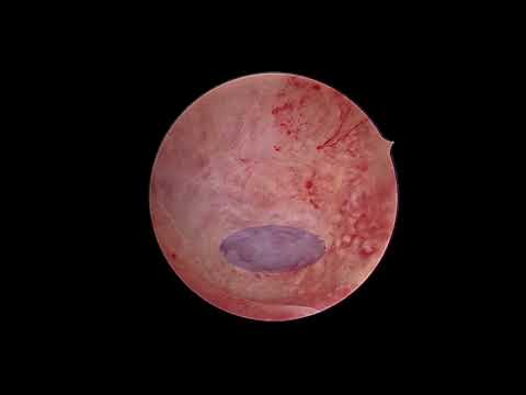 Repair of a Chronic Myometrial Defect with successful pregnancy outcome.
