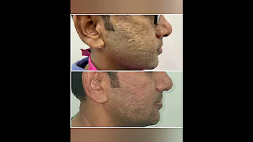 Acne Scar Treatment Fractional CO2 Laser Subcision MnRF With Vampire Facial Face PRP Short 