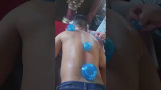Cupping or Vendosa Massage $50  15 minutes Deerfield Riverwoods Buffalo Grove