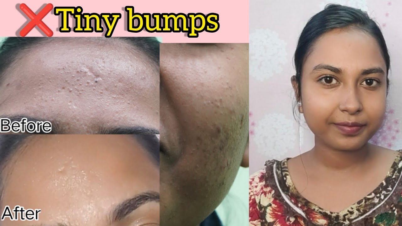 How to remove tiny bumps(fungal acne) on forehead in tamil|How I cured my fungal acne in tamil|