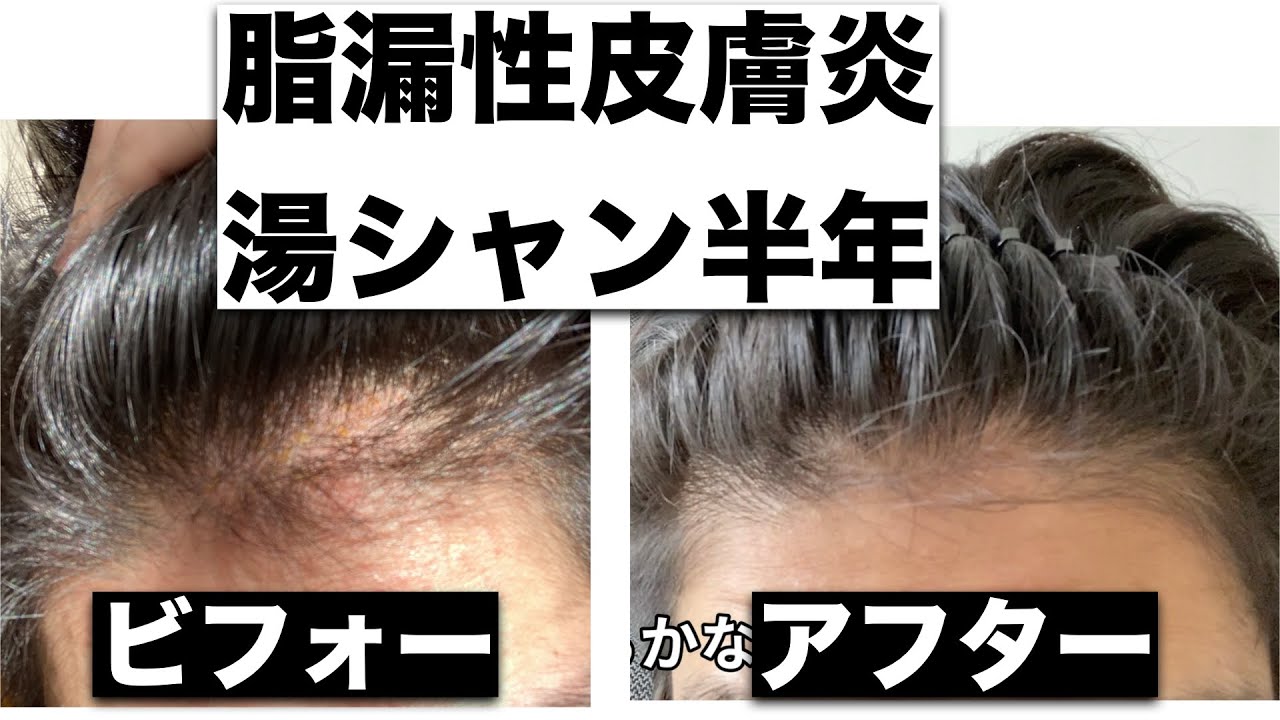 脂漏性皮膚炎シャンプー辞めて半年後のビフォーアフターがこちら - YouTube